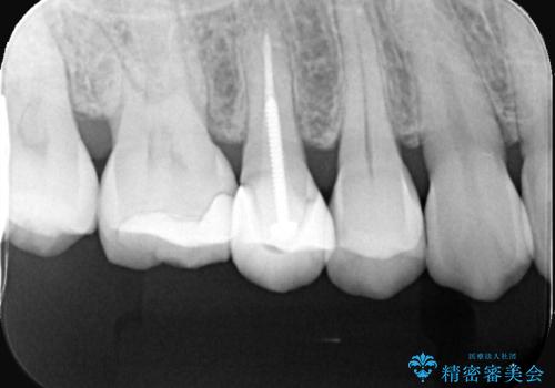 古い被せ物の中のむし歯を治療の治療前