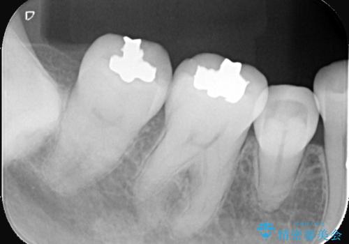 【セラミックインレー】口の中の銀の詰め物を白い物に替えたいの治療前