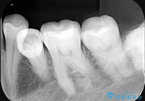 【セラミックインレー】口の中の銀の詰め物を白い物に替えたいの治療後