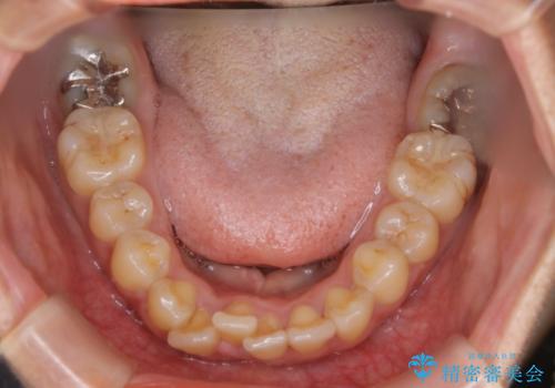 前歯を後ろに下げたい ワイヤー矯正(クリア装置)の治療前