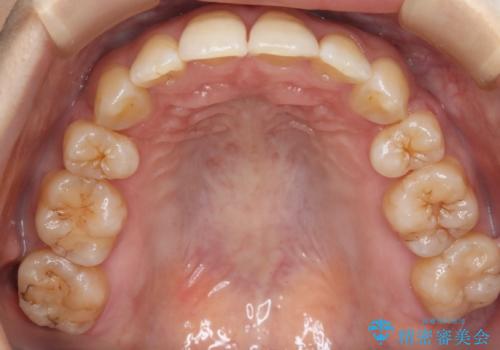 前歯を後ろに下げたい ワイヤー矯正(クリア装置)の治療後