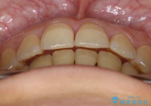 前歯を後ろに下げたい ワイヤー矯正(クリア装置)の治療後