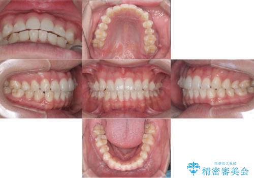 歯のデコボコを治したい|インビザラインで綺麗な歯並びに!|矯正期間は6ヵ月!の治療中