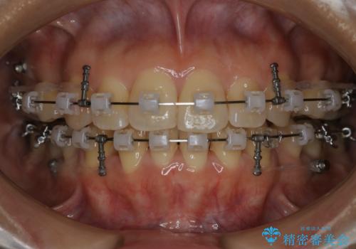 前歯を後ろに下げたい ワイヤー矯正(クリア装置)の治療中