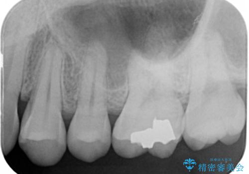 銀歯をやり変えたい セラミックインレーの治療前