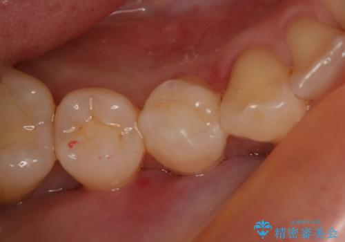 虫歯のところをセラミックで直したい セラミックインレー