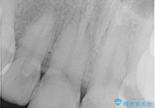 前歯の根のところに違和感がある|根尖性歯周炎|精密根管治療|オールセラミッククラウン|見た目も改善の治療前