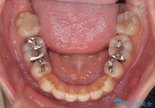 八重歯を矯正治療で治したい!の治療後