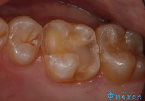 銀歯をやり変えたい セラミックインレーの治療中