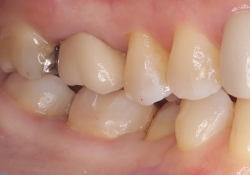 【セラミックインレー】口の中の銀の詰め物を白い物に替えたいの治療後