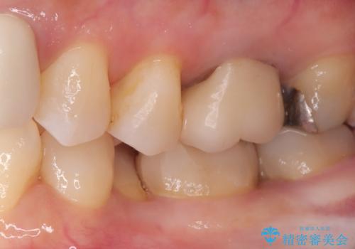 【セラミックインレー】口の中の銀の詰め物を白い物に替えたいの治療後