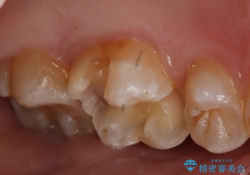 銀歯をやり変えたい セラミックインレーの治療中