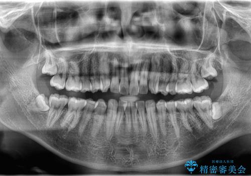 歯のデコボコを治したい|インビザラインで綺麗な歯並びに!|矯正期間は6ヵ月!の治療前