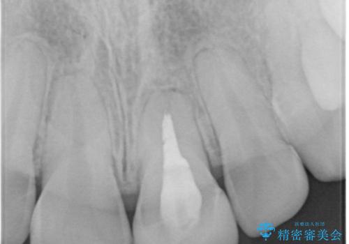 変色した歯をきれいにしたい セラミック治療の治療前