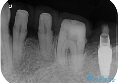 歯周病再生治療と歯周ポケット除去 歯周外科手術の治療中
