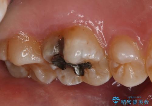 銀歯をやり変えたい セラミックインレーの治療前
