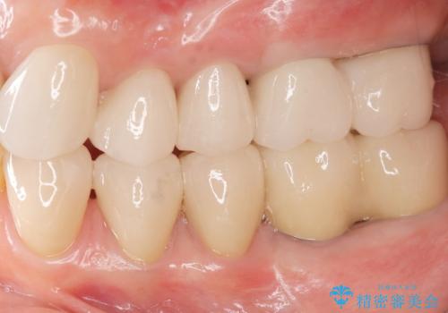 全顎 虫歯 インプラント治療の治療後