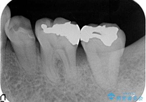歯周病再生治療と歯周ポケット除去 歯周外科手術の治療前