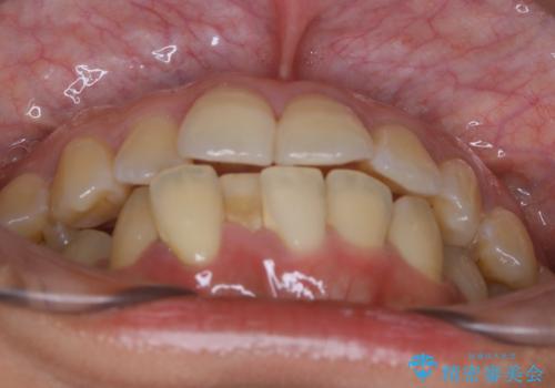 前歯を後ろに下げたい ワイヤー矯正(クリア装置)の治療前