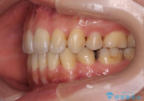 八重歯を矯正治療で治したい!の治療後