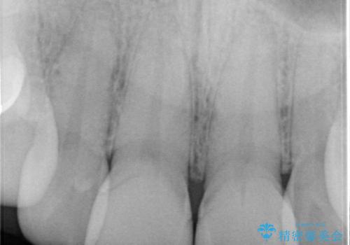 前歯の根のところに違和感がある|根尖性歯周炎|精密根管治療|オールセラミッククラウン|見た目も改善の治療前