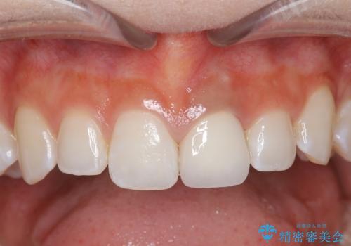 変色した歯をきれいにしたい セラミック治療の症例 治療後