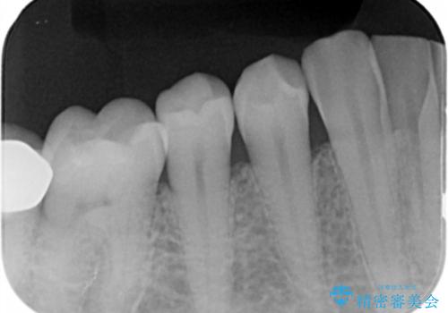 虫歯のところをセラミックで直したい セラミックインレーの治療前