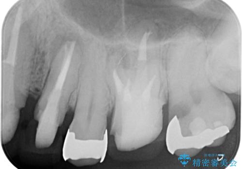 銀歯・虫歯・治療途中の歯を治していきたいの治療中