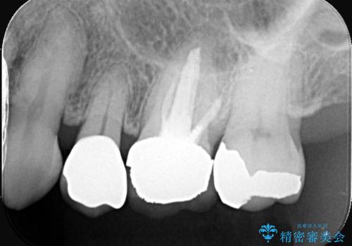 虫歯と古い被せ物をきれいに修復の治療後