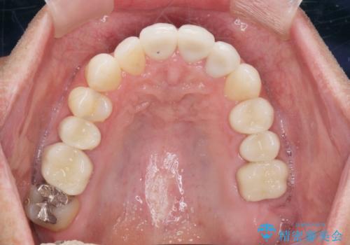 矯正と虫歯のセラミック治療 総合歯科治療の実践の治療後