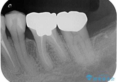 銀歯の除去 長期的な未来を見据えた虫歯治療の治療前