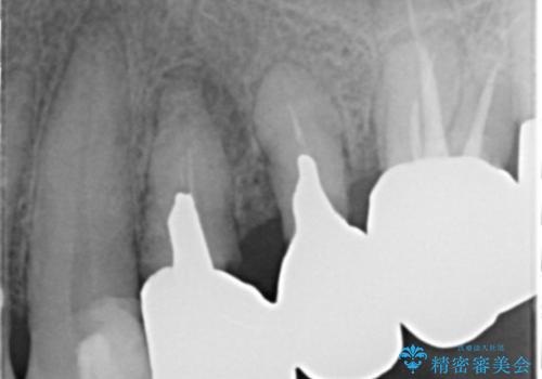 銀歯の除去 長期的な未来を見据えた虫歯治療の治療前