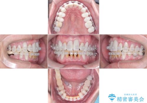 歯がボロボロで咬合崩壊 矯正・インプラント・セラミックで実現する、酸蝕症の総合治療の治療中