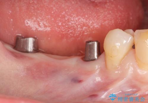 失った奥歯をインプラントで機能回復の治療中