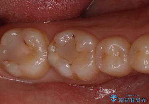 奥歯の虫歯を直したい　セラミックインレーの治療前