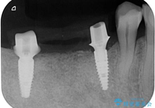 失った奥歯をインプラントで機能回復の治療中