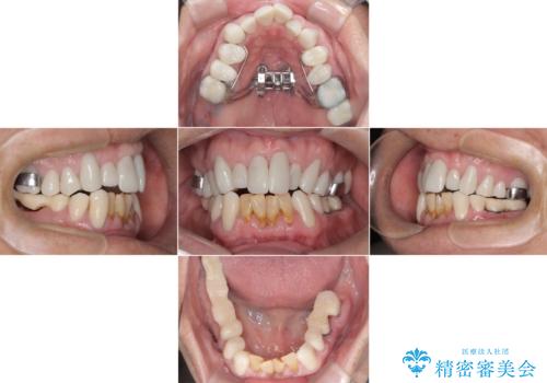 歯がボロボロで咬合崩壊 矯正・インプラント・セラミックで実現する、酸蝕症の総合治療の治療中