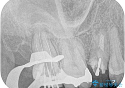 奥歯の根の病変も精密治療で解決の治療中