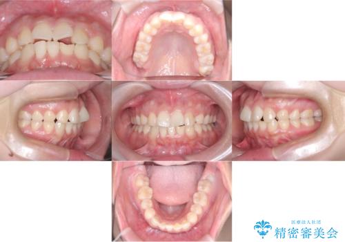 歯のデコボコを治したい! |インビザラインでわずか6ヵ月で矯正完了!の治療前