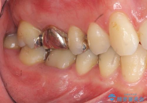 矯正と虫歯のセラミック治療 総合歯科治療の実践の治療前