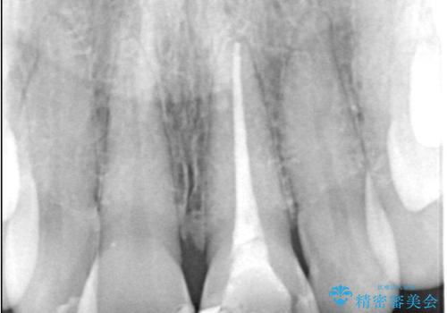 前歯の変色を改善し、本来の自然な美しさへの治療前