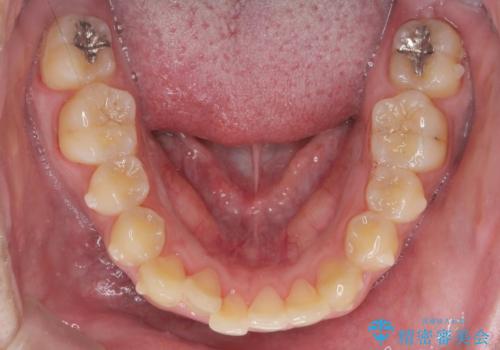 正中過剰埋伏歯で生じた前歯の審美障害 矯正治療での改善の治療中