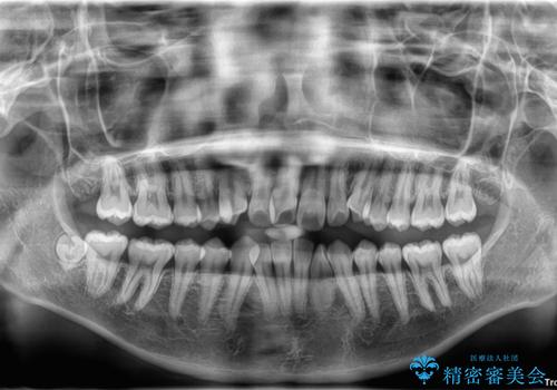 【モニター】前歯のデコボコをスッキリ解消!目立ちにくいワイヤー矯正でスピーディに治療完了の治療前