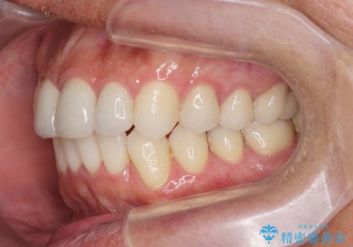 矯正と虫歯のセラミック治療 総合歯科治療の実践の治療後