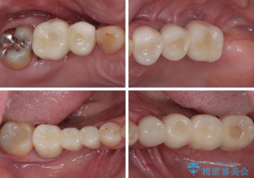 欠損の多い奥歯 インプラントによる補綴治療の治療後