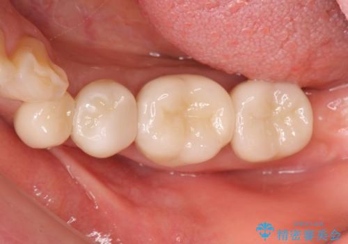銀歯の除去 長期的な未来を見据えた虫歯治療の治療後
