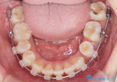 がたつきと出っ歯 ワイヤー矯正での歯並び改善の治療中