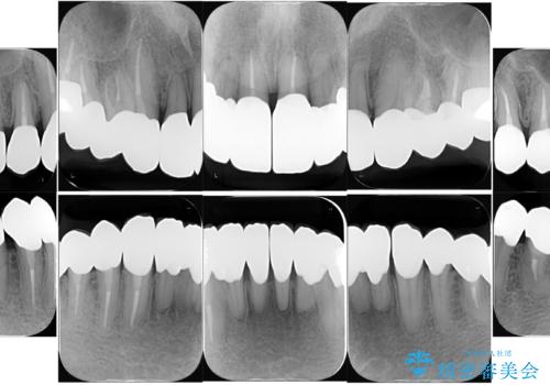 歯がボロボロで咬合崩壊 矯正・インプラント・セラミックで実現する、酸蝕症の総合治療の治療後