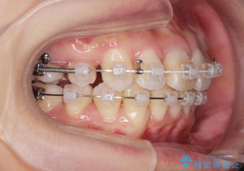 がたつきと出っ歯 ワイヤー矯正での歯並び改善の治療中