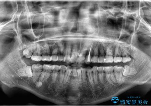 歯のデコボコを治したい! |インビザラインでわずか6ヵ月で矯正完了!の治療前